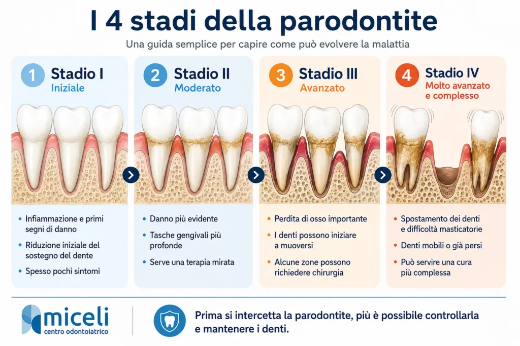 Infografica sui 4 stadi della parodontite con evoluzione della malattia, perdita di osso, mobilità e difficoltà masticatorie