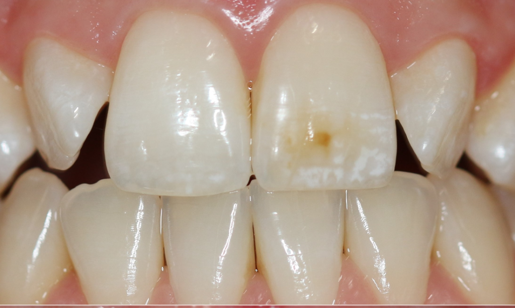 Come eliminare le macchie marroni dai denti? - Dentista a Napoli e San  Giorgio a Cremano - Studio Odontoiatrico Leonardo Miceli