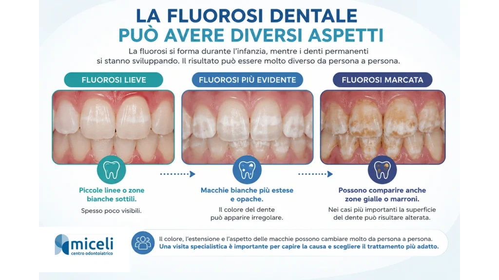 Diversi aspetti della fluorosi dentale da lieve a marcata