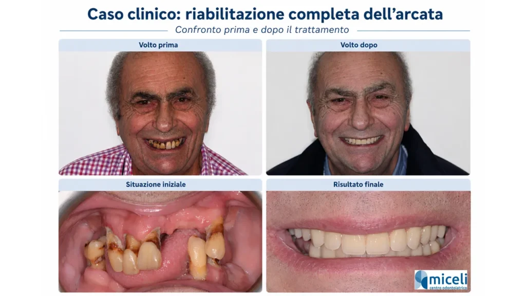 Caso clinico di riabilitazione completa dell’arcata con confronto prima e dopo il trattamento