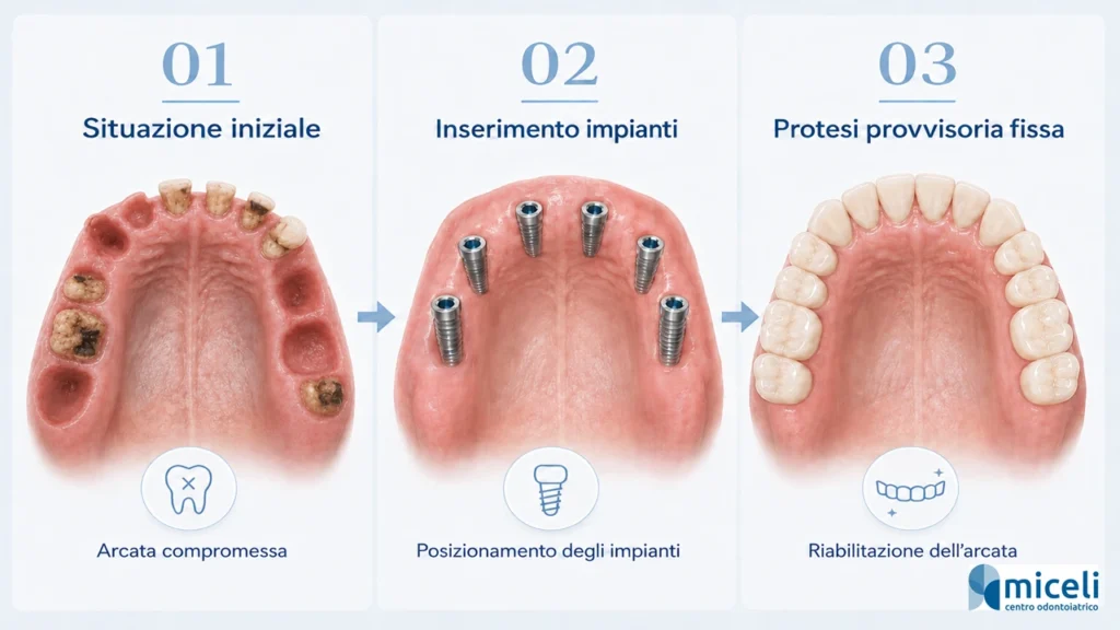 Fasi dell’implantologia post estrattiva con inserimento degli impianti e protesi provvisoria fissa