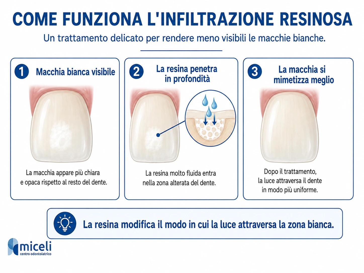 Come funziona l’infiltrazione resinosa per trattare le macchie bianche sui denti