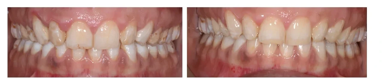 Fluorosi dentale prima e dopo macroabrasione vista frontale