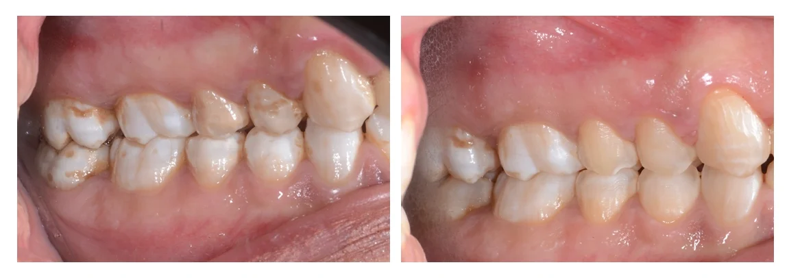 Fluorosi dentale prima e dopo macroabrasione lato destro