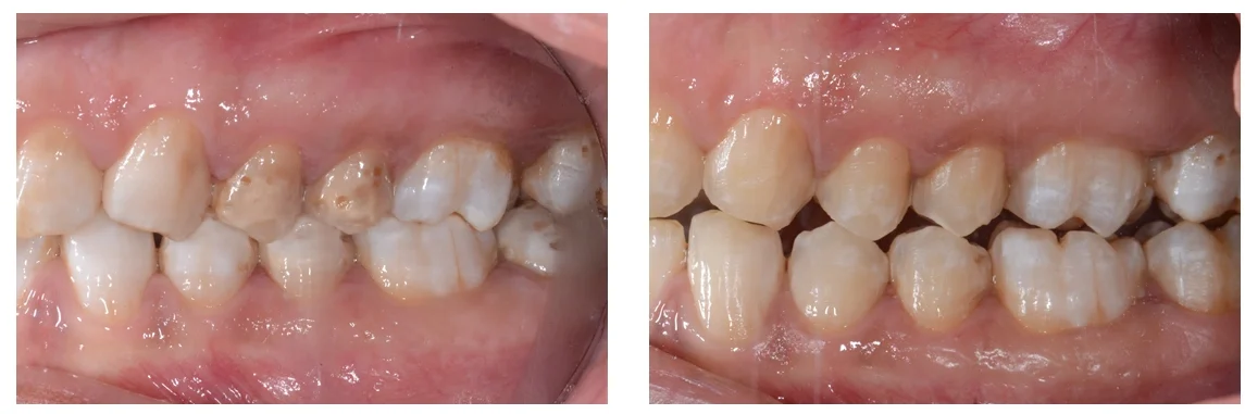 Fluorosi dentale prima e dopo macroabrasione lato sinistro